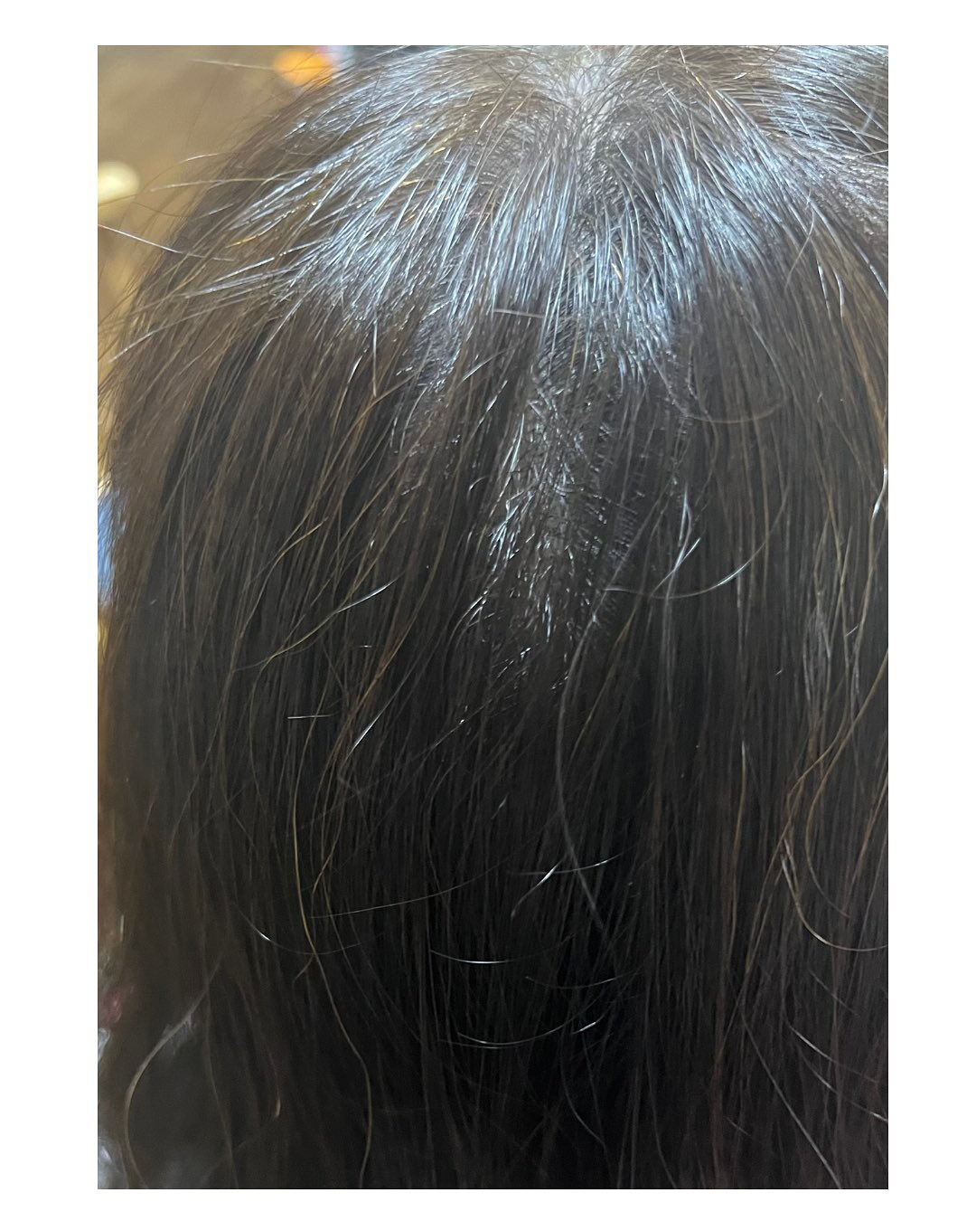 つむじの割れ、気になっていませんか？